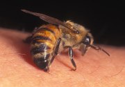 bee sting